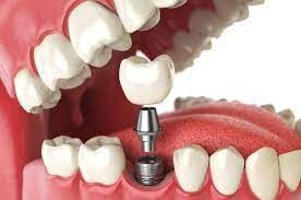 A glimpse into having teeth implant and tooth care